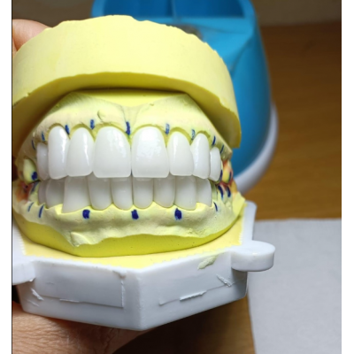 Dental Implant Bar For Crowns And Bridge ，Chinese Dental Laboratory