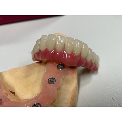 Full-Arch Dental Implant-Supported Bridges Dental Implants