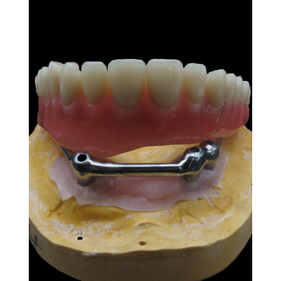 China Dental Lab Composite Implant Bridge