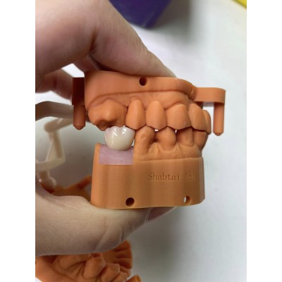 screwed implant bridge full jaw with pink porcelain and open embrassure.