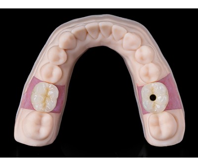 hybrid implant bridge , MYY Dental Lab