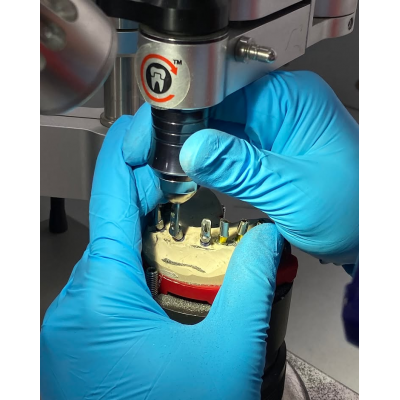 screwed implant bridge full jaw with pink porcelain and open embrassure.
