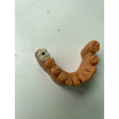 Screw-Retained Dental Implants MYY Dental Lab China