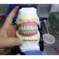 Full Arch PMMA Restorations with Titanium Bar