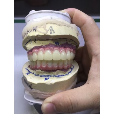 Cementable Custom Titanium Abutments