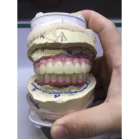 Cementable Custom Titanium Abutments