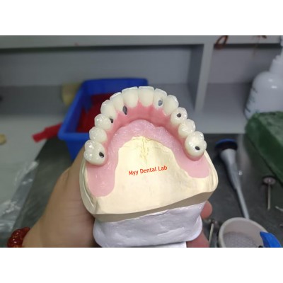 Screw-Retained Dental Implants