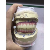 All-Zirconia Screw-Retained Bridges