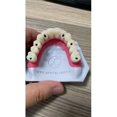 Titanium Hybrid Dentures