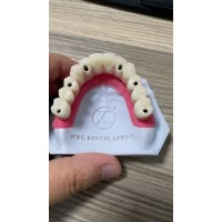 Titanium Hybrid Dentures